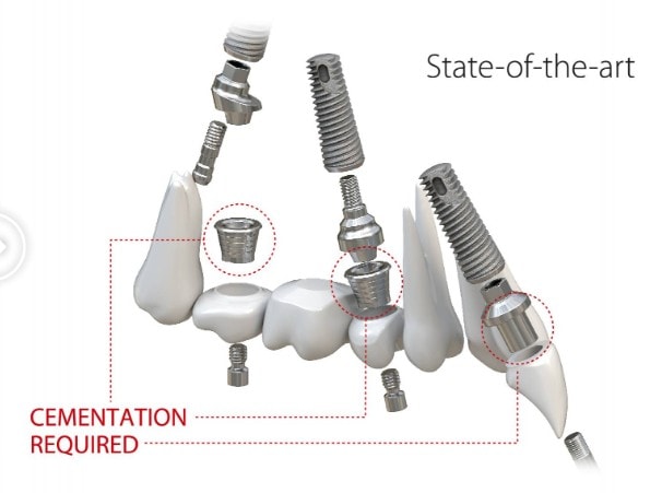 Soluții clasice de implantologie dentară bazate pe sisteme de legătură între implant și lucrarea protetică - dr. Adina Fulea